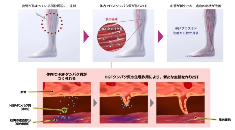 HGF遺伝子治療薬、動脈硬化