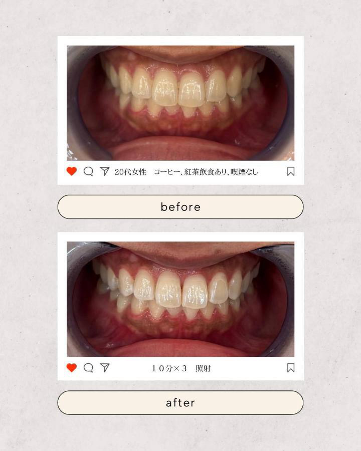 都島区　セルフホワイトニング